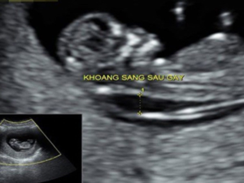 Độ mờ da gáy là sự kết tụ của chất dịch dưới da ở vùng gáy của thai nhi.