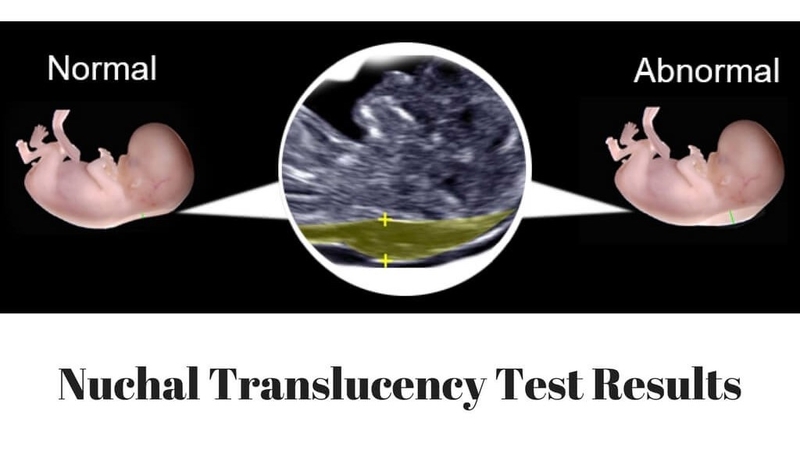 Đo nếp gấp da gáy ở thai nhi là gì? 1