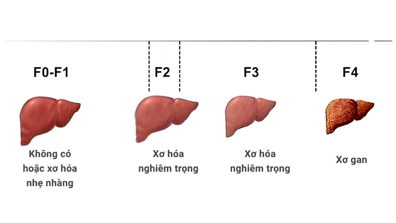 Độ xơ hóa gan F0 - F1 cho thấy gan chưa xơ hóa hoặc chỉ tổn thương rất nhẹ