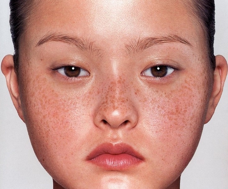 Đồi mồi bị đỏ xuất hiện ở má? Nguyên nhân và cách khắc phục 1