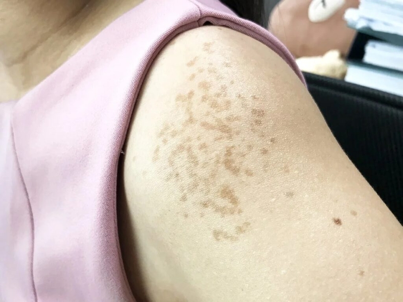 Đồi mồi là gì? Bị đồi mồi có trị được không? 2