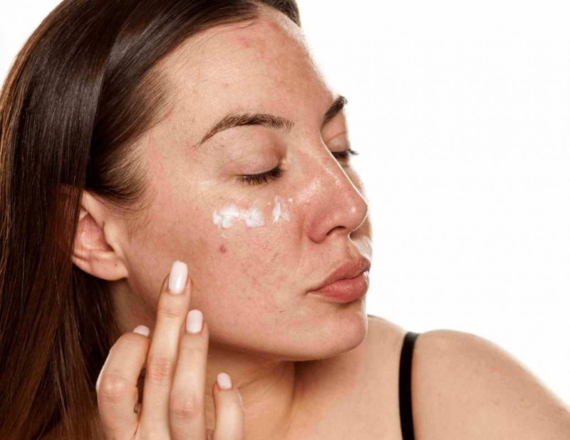 Đồi mồi là gì? Bị đồi mồi có trị được không? 4