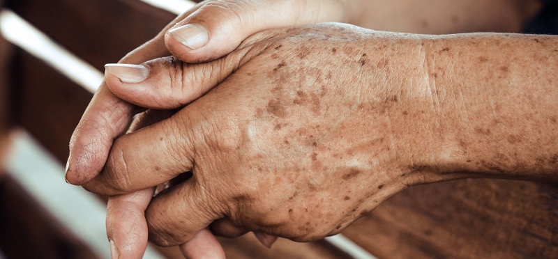 Đồi mồi – dấu hiệu sự lão hóa4