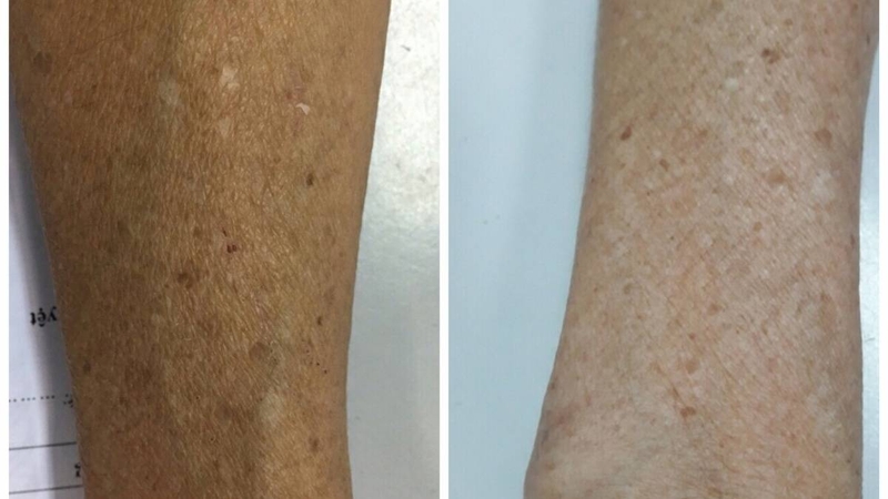 Đồi mồi ở chân và những điều cần biết 1