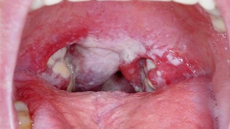 Đối tượng dễ nhiễm nấm họng ở người lớn là ai 1