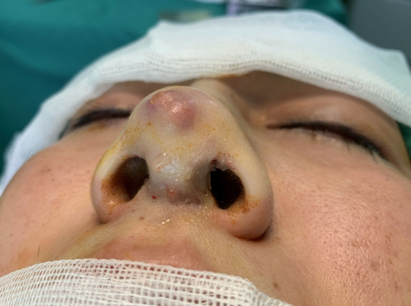 Đối tượng nào cần tháo bỏ silicon nâng mũi 2