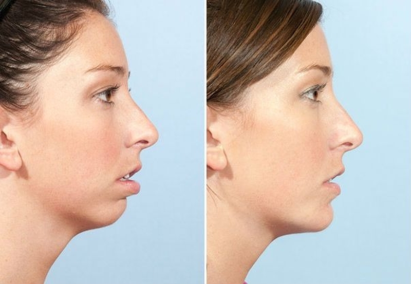 Độn cằm bao lâu hết sưng? Tìm hiểu về phẫu thuật độn cằm2