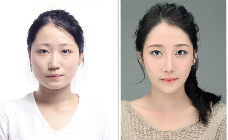 Độn cằm bao lâu hết sưng? Tìm hiểu về phẫu thuật độn cằm1