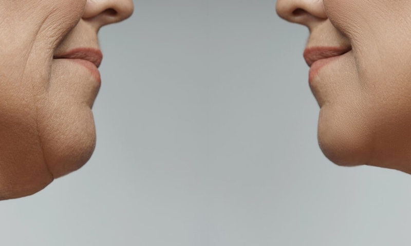 Độn cằm duy trì được bao lâu - bạn đã biết chưa?1