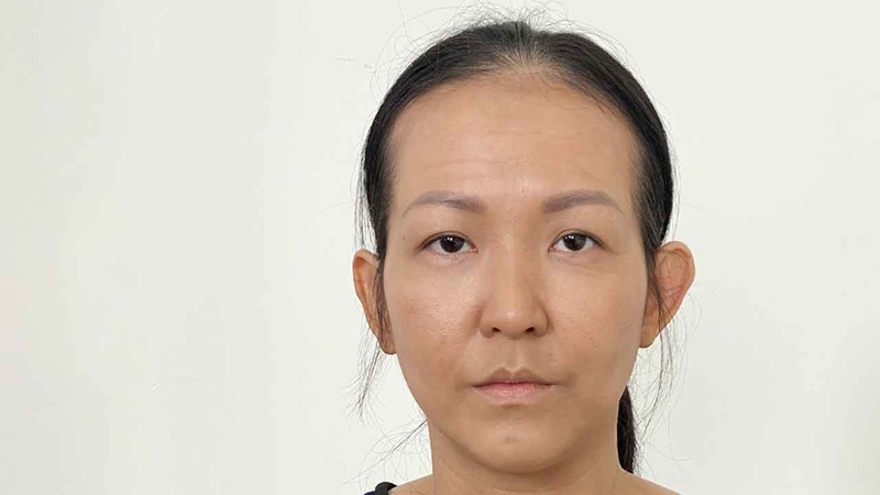 Độn thái dương có được vĩnh viễn không?1