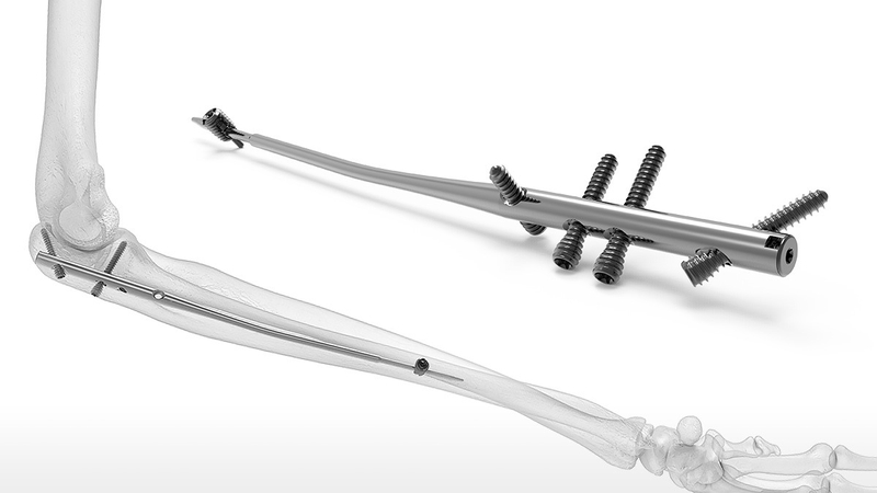 Đóng đinh nội tủy là thế nào? Ưu điểm và rủi ro của phương pháp đóng đinh nội tủy 3