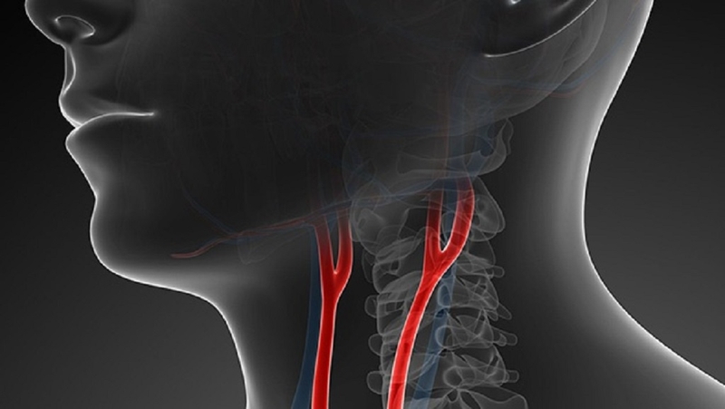 Động mạch cảnh là gì? Nhận biết các triệu chứng liên quan đến bệnh động mạch cảnh 1