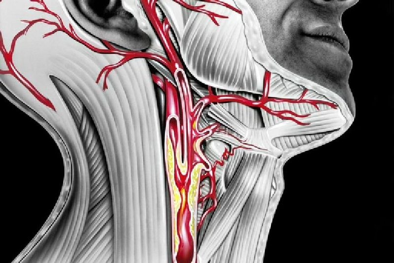 Động mạch cảnh là gì? Nhận biết các triệu chứng liên quan đến bệnh động mạch cảnh 2