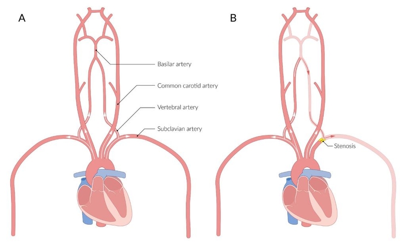 Động mạch dưới đòn: Nguyên ủy, đường đi và các nhánh mạch máu cung cấp vùng đầu, mặt, cổ 3