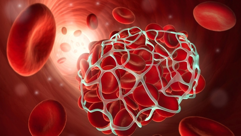 Đông máu rải rác trong lòng mạch là gì? Nguyên nhân và triệu chứng của bệnh 1