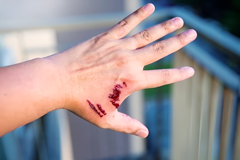 Động vật cắn phải làm sao? Cách sơ cứu khi động vật cắn 2