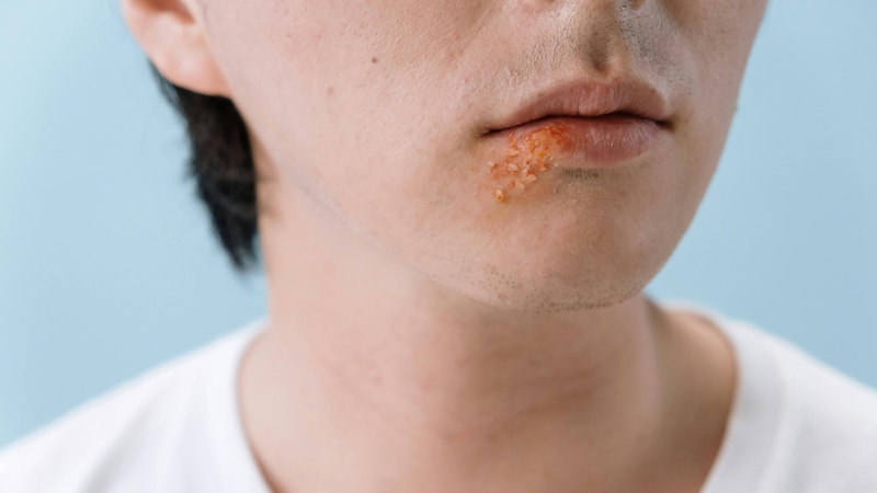 Một số virus như herpes có thể chèn ADN vào bộ gen vật chủ làm đứt gãy nhiễm sắc thể