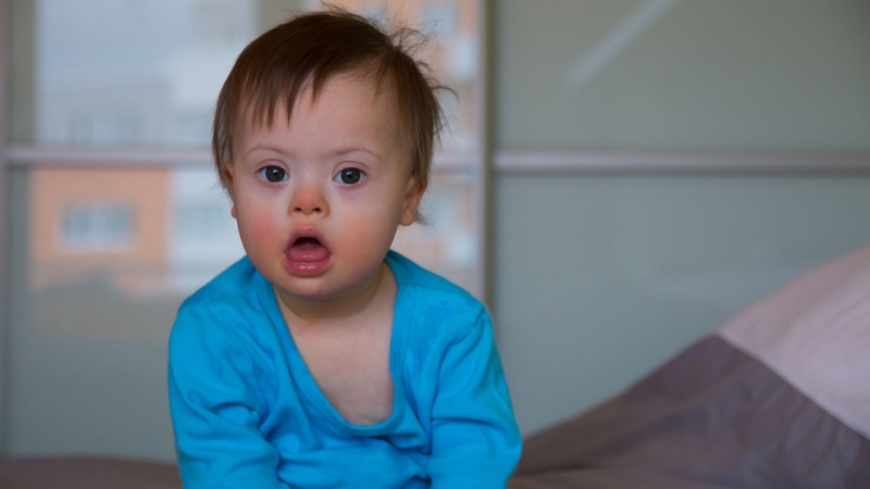 Đột biến gây hội chứng Down làm chậm phát triển trí tuệ và gây nhiều dị tật bẩm sinh