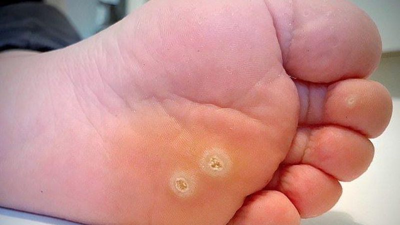 Đốt mụn cóc bằng laser và những lưu ý cần biết 1