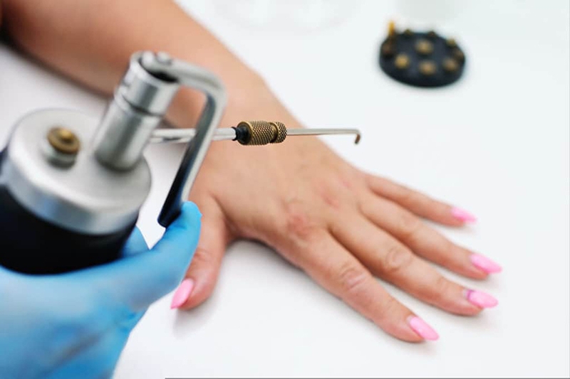 Đốt mụn cóc bằng laser và những lưu ý cần biết 3