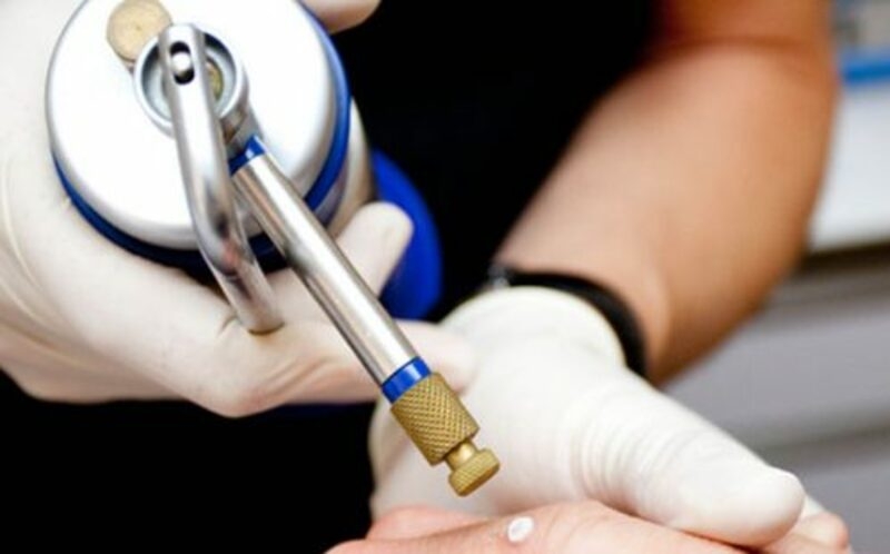 Đốt mụn cóc bằng laser và những lưu ý cần biết 4