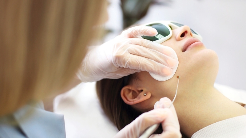 Đốt mụn thịt giá bao nhiêu? Cách chăm sóc sau khi đốt mụn thịt 2