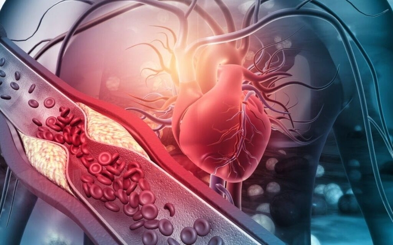 Đột quỵ thân não: Nguyên nhân, triệu chứng, chẩn đoán và điều trị 2