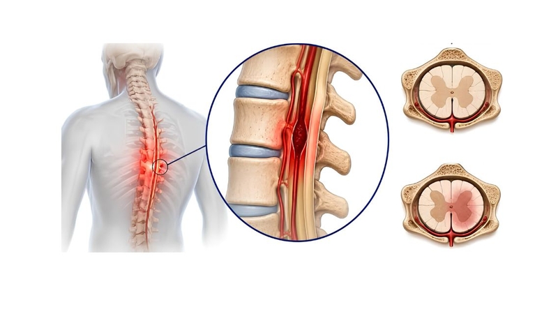 Phục hồi chức năng hỗ trợ cải thiện vận động sau tổn thương tủy