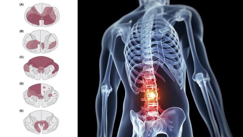 Nhồi máu tủy sống có thể gây yếu hoặc liệt đột ngột