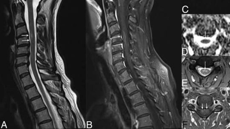 Đột quỵ tủy sống ảnh hưởng đến vận động và cảm giác