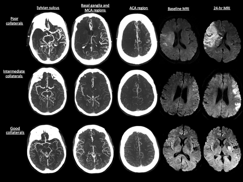 Đột quỵ và tai biến có giống nhau không? 2