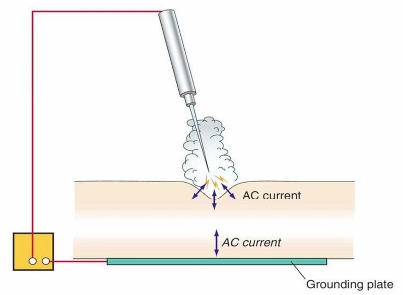 Đốt sùi mào gà bằng sóng cao tần diễn ra như thế nào? 2