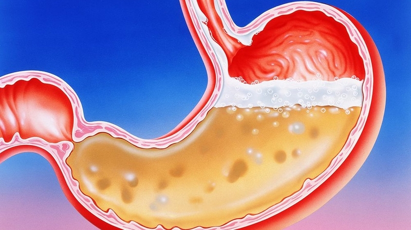 Dư axit dạ dày: Nguyên Nhân, triệu chứng và giải pháp khắc phục 1