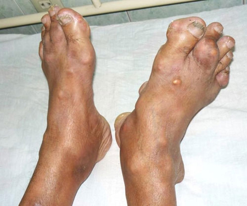 Chữa Gout bằng dừa xiêm và lá trầu - Sự kết hợp hoàn hảo cho bệnh nhân Gout