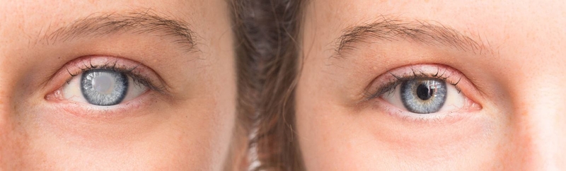 Đục thủy tinh thể có nên mổ không? 2