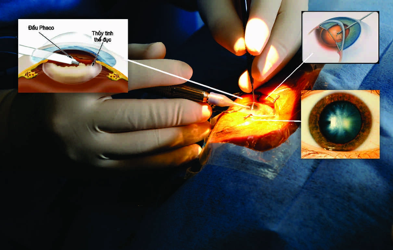 Đục thủy tinh thể có nên mổ không? 3