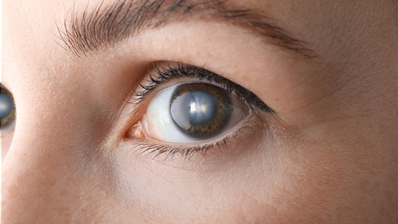 Đục thủy tinh thể có nguy hiểm không? Câu trả lời là có vì có thể hủy hoại cấu trúc nhãn cầu