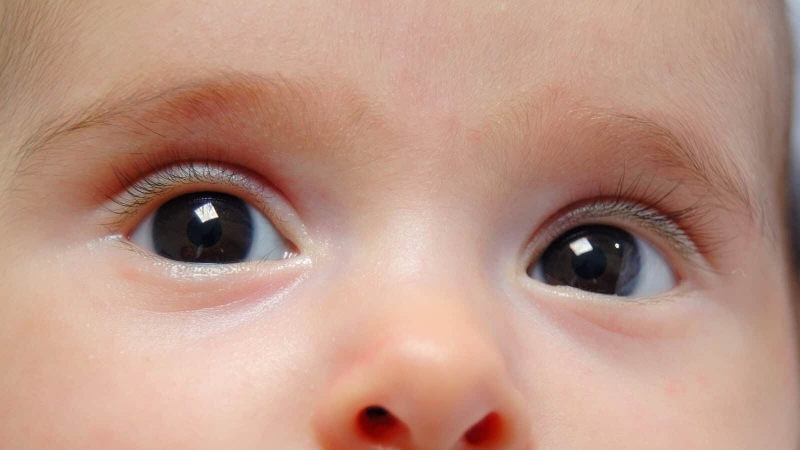 Đục thủy tinh thể ở trẻ sơ sinh là bệnh hiếm gặp