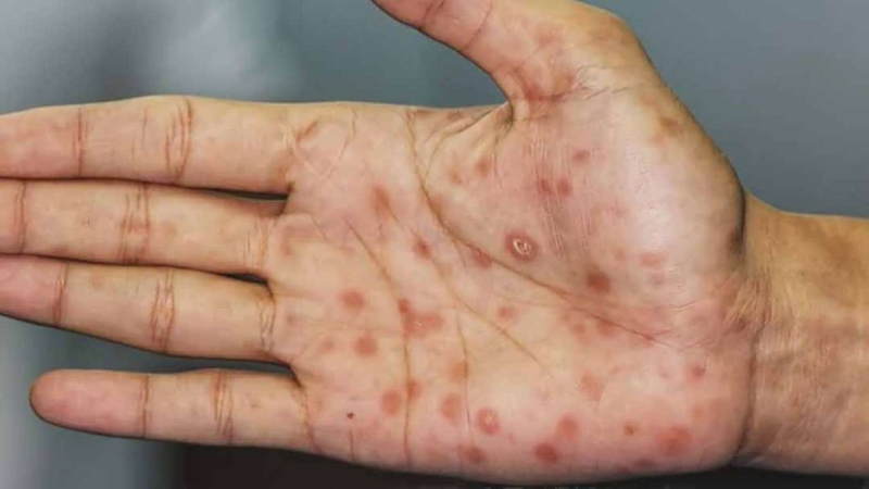 Các bệnh lây qua đường tình dục bao gồm cả giang mai