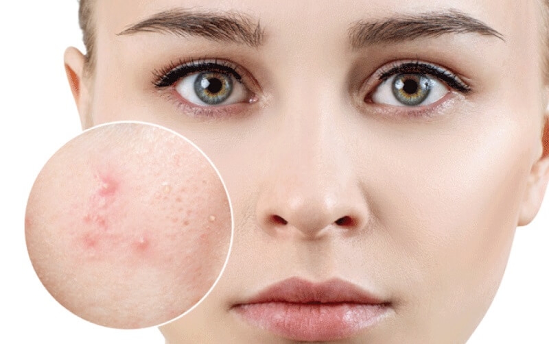 Dùng BHA bao lâu thì đẩy mụn? Phân biệt kích ứng và đẩy mụn 1