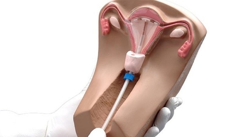 Dùng cốc nguyệt san giảm đau bụng kinh có đúng không? 2