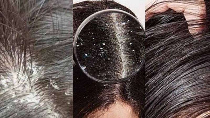 Dùng dầu gội làm sạch gàu Vichy Dercos: Ngăn gàu quay lại! 1