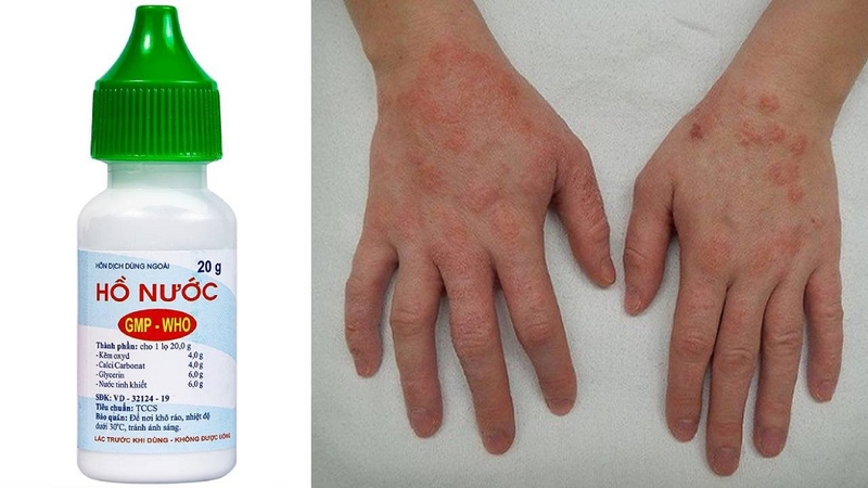 Dùng hồ nước bôi chàm sữa được không? Cần lưu ý gì khi dùng cho bé 1