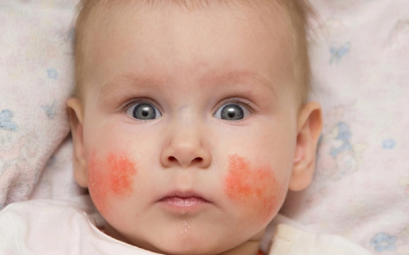 Dùng hồ nước bôi chàm sữa được không? Cần lưu ý gì khi dùng cho bé 2