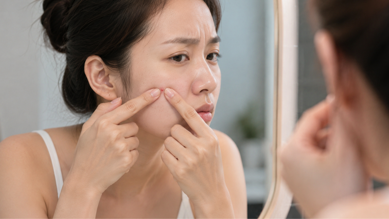 Tự nặn mụn có thể làm tăng viêm, để lại sẹo và thâm sau mụn