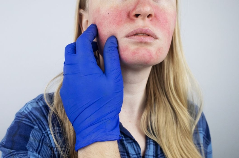 Cần làm gì khi dùng nước tẩy trang bị rát mặt 4