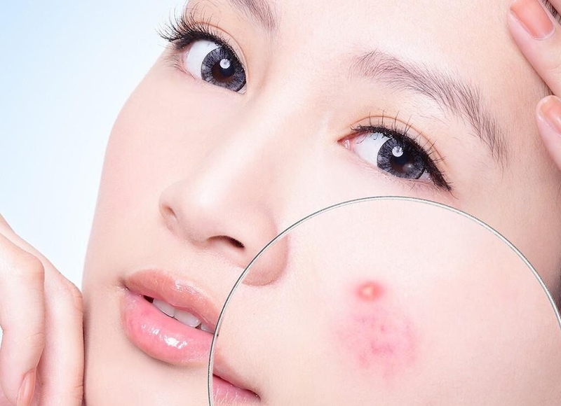 Dùng Povidine trị mụn được không? Cách sử dụng Povidine để trị mụn hiệu quả 2