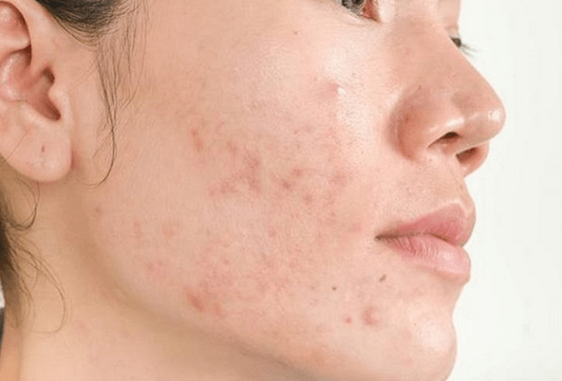 Dùng retinol bị lên mụn xử trí như thế nào?-2