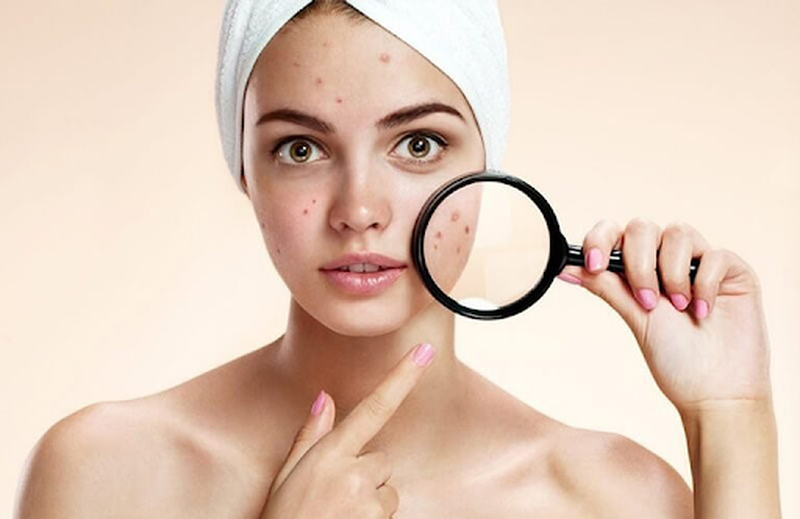 Tìm hiểu nguyên nhân dùng sữa rửa mặt bị nổi mụn 1