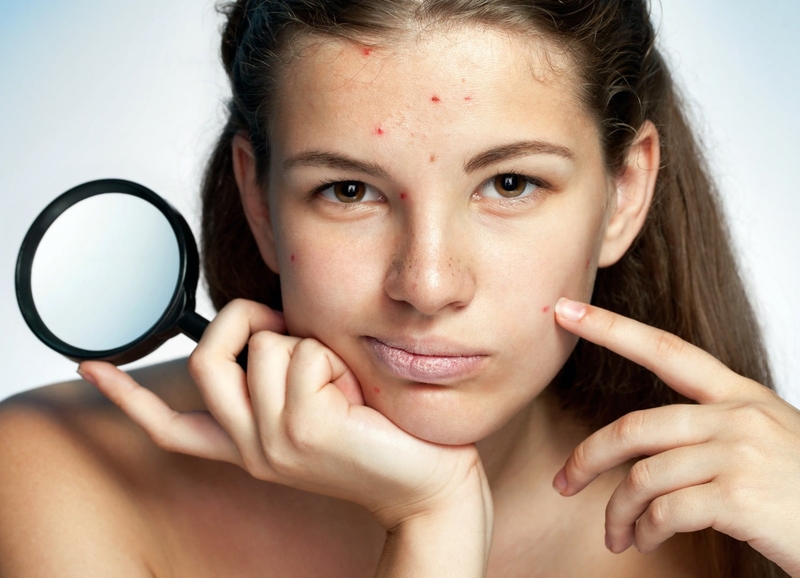 Dùng treatmnet bị lên mụn là do đâu 1